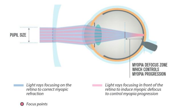 Tròng Kính Kiểm Soát Cận Thị Trẻ Em Rocky Myopia Control 360 Độ - Ảnh 3