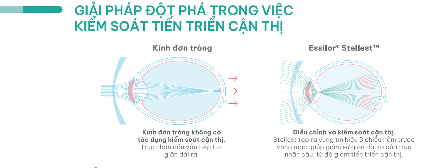 Tròng kính Essilor Stellest kiểm soát tiến triển cận thị cho trẻ em.