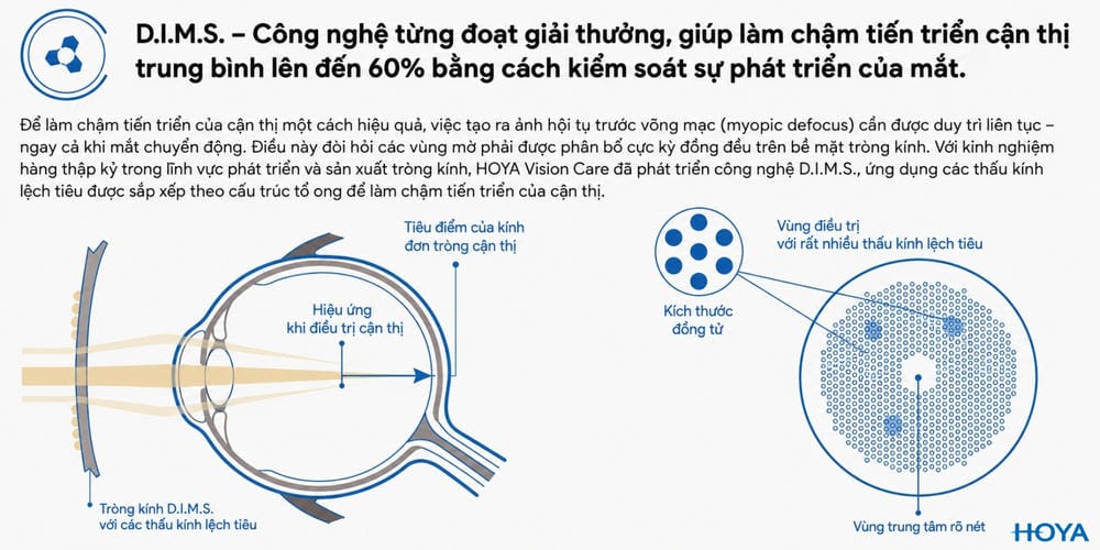 Hoya MiYOSMART 1.59 - 4 Sự Lựa Chọn Phù Hợp Cho Trẻ Em Cận Thị